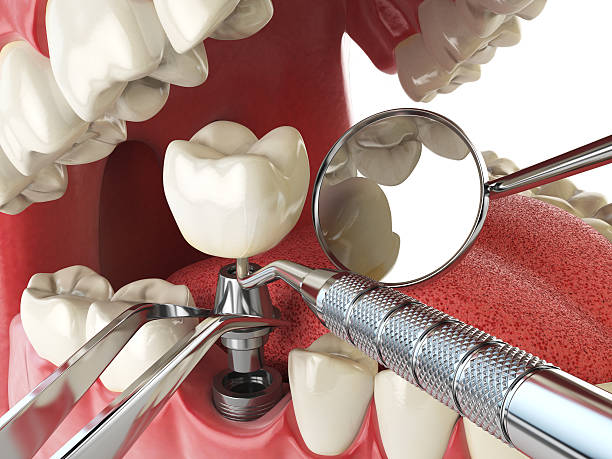 Best Emergency Root Canal Treatment in Wrightsville, GA